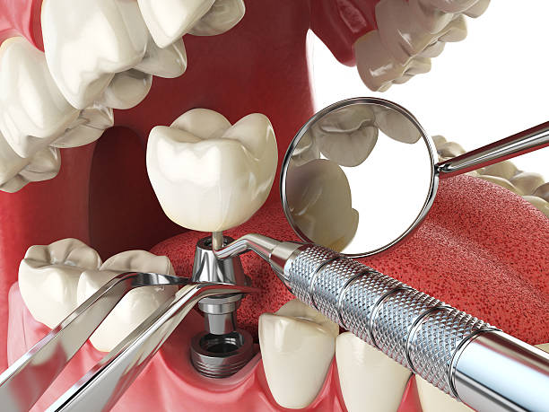 Best Emergency Wisdom Teeth Removal in Crafton, PA